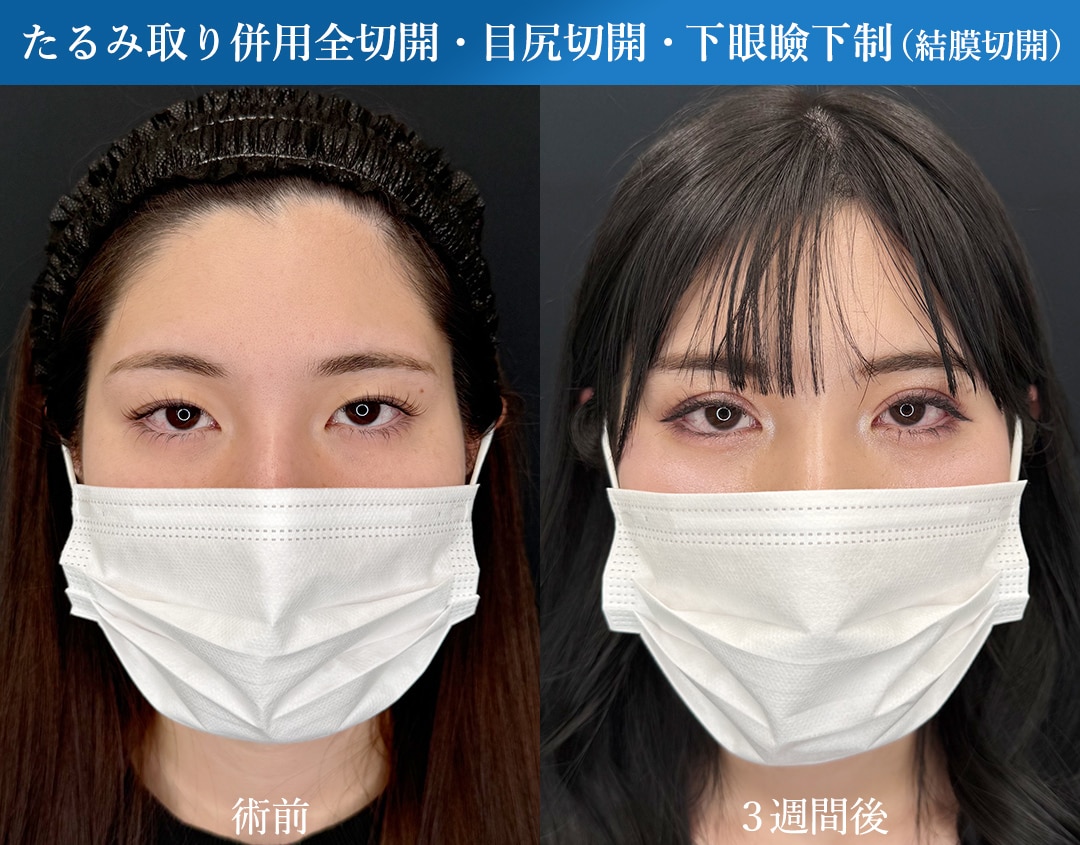 埋没法で後悔したくない、まぶたの厚い方へ