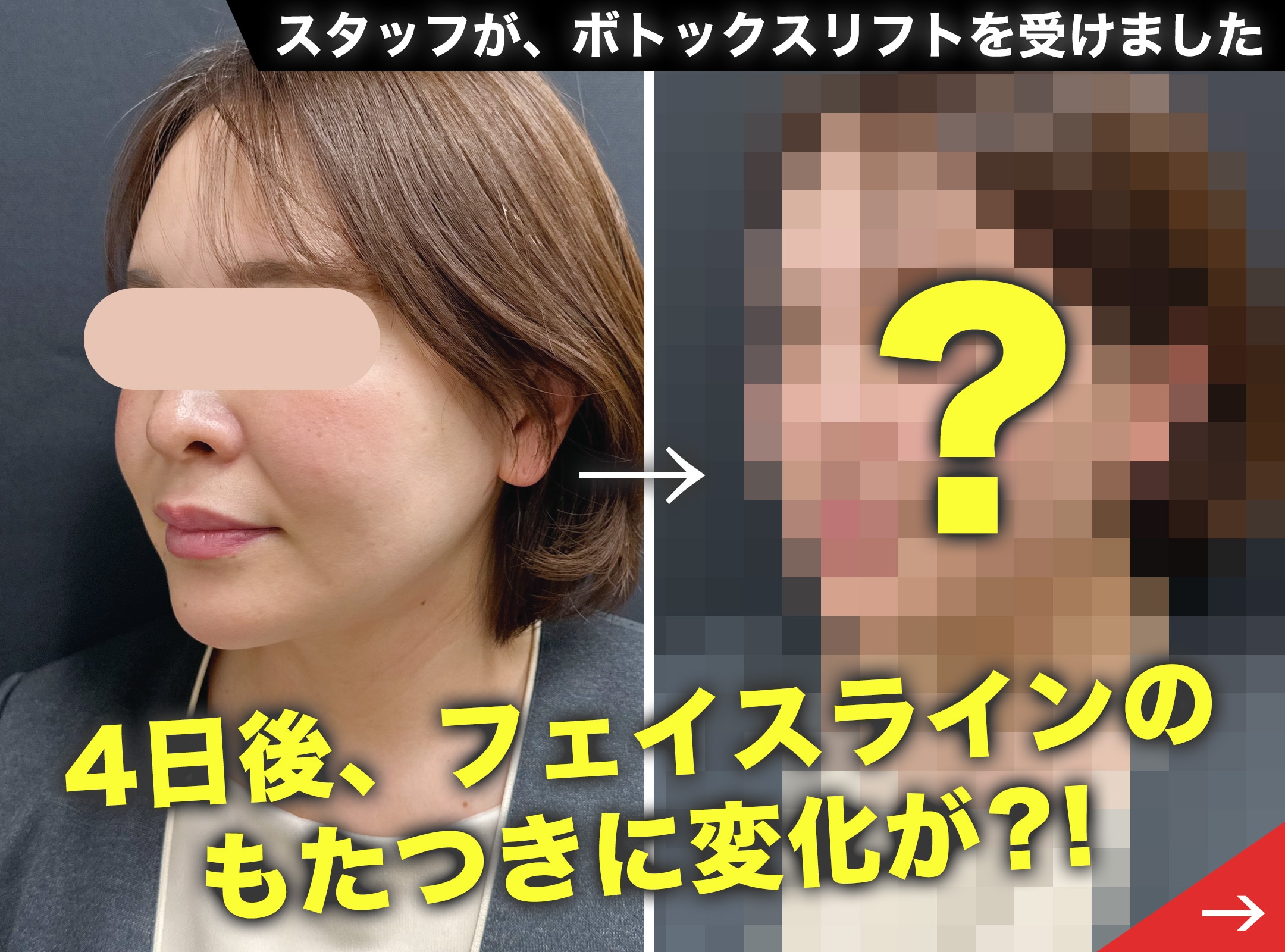 【2月限定価格あり】冬の強張りをリセット！2月からはじめるボトックスリフト習慣