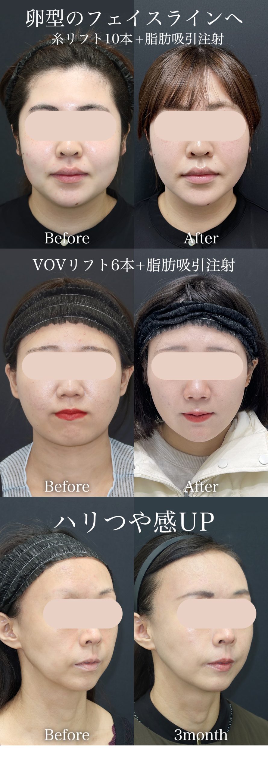 【4/15まで】シュッと引き締め！小顔を叶える「糸リフト」