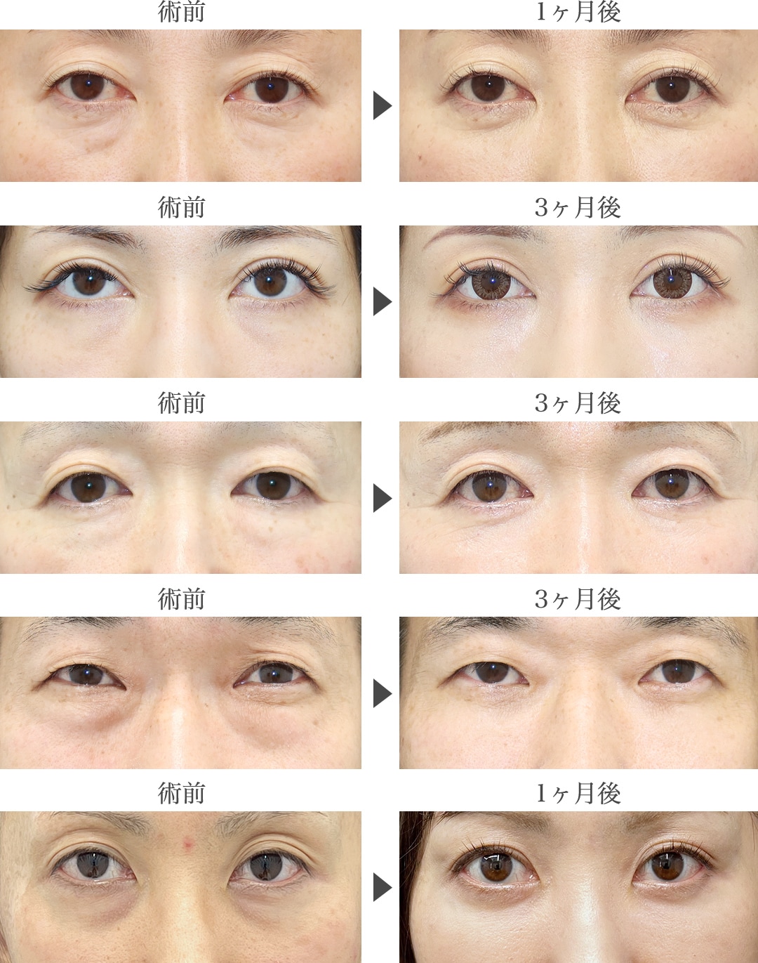 【3/31まで】影を消して明るい表情へ✨「目の下のクマ取り」