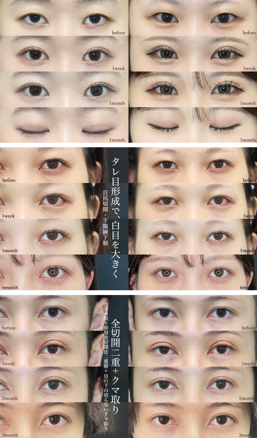 【大嶋医師の推し治療】凛とした眼差しを。「二重・目元形成」