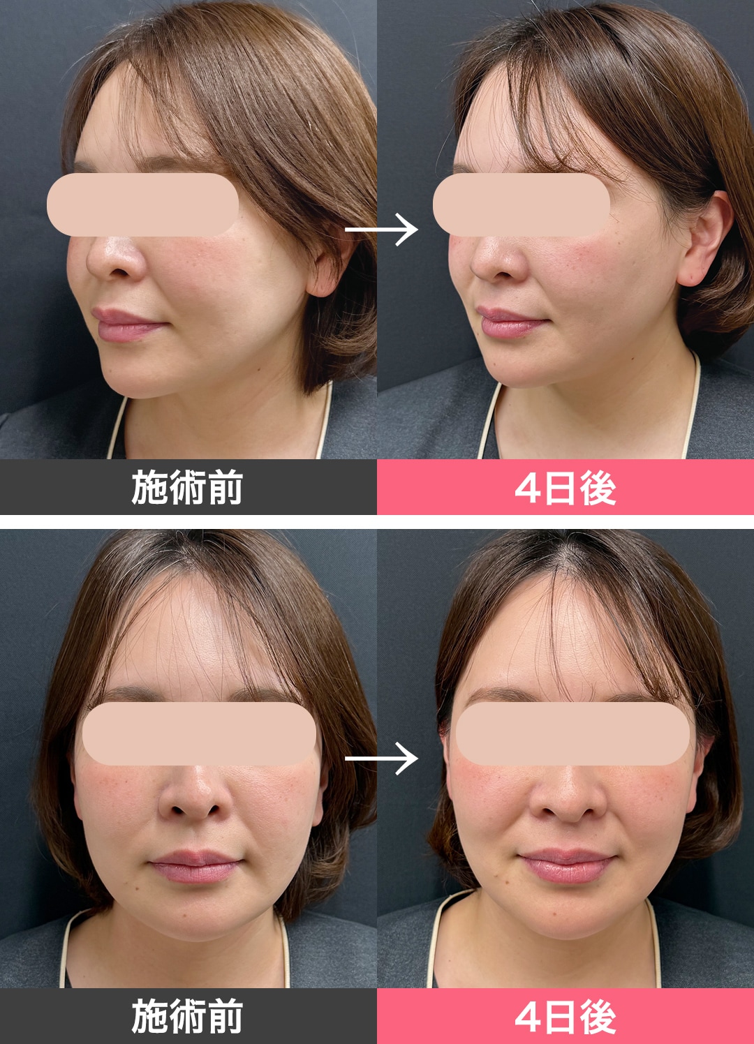 気になる効果は？ビフォー・アフター公開