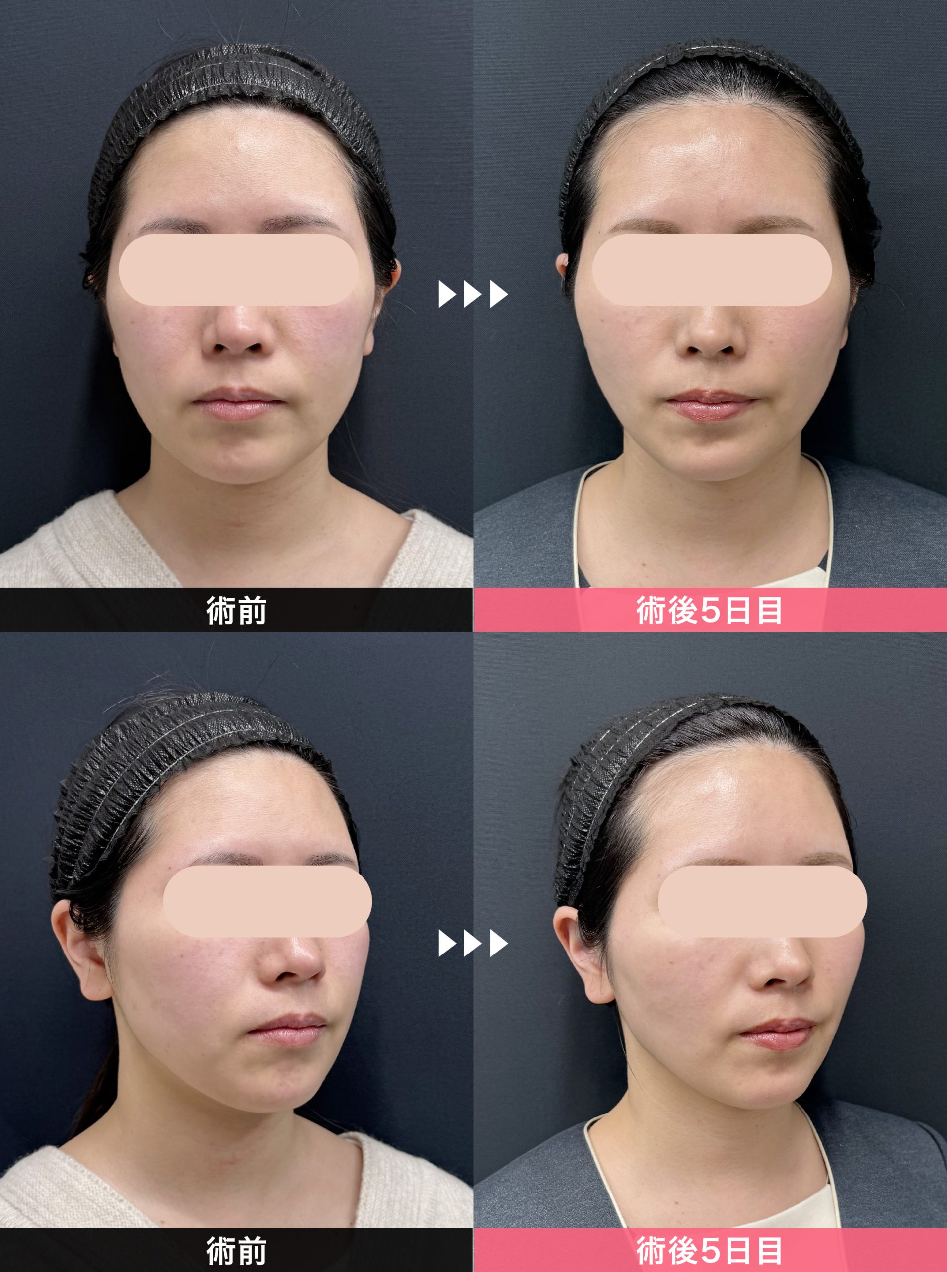 術前 vs 術後5日目の変化がこちら