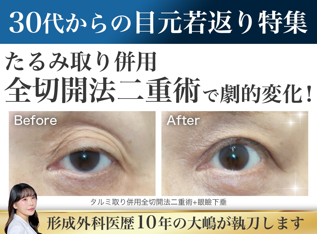 30代からの瞼のたるみに！たるみ取り併用全切開法二重術で叶える目元の若返り術｜SBC横須賀中央院
