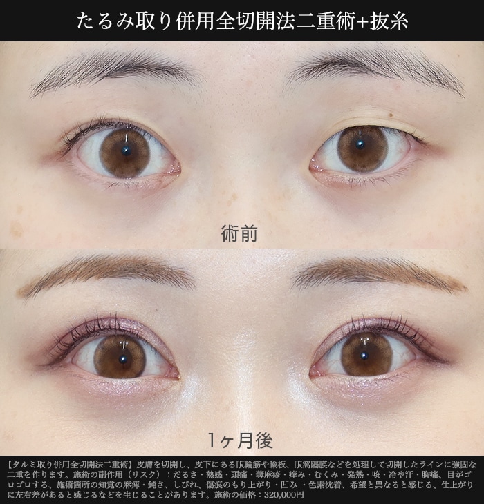 半永久的な二重のライン