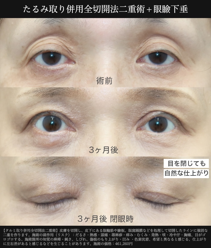 目元がパッチリ若返る
