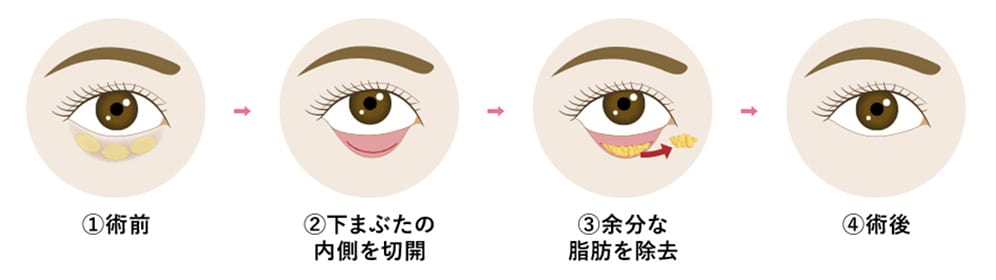 下まぶたの裏側から脂肪を取り除く、傷跡の残らないクマ取り