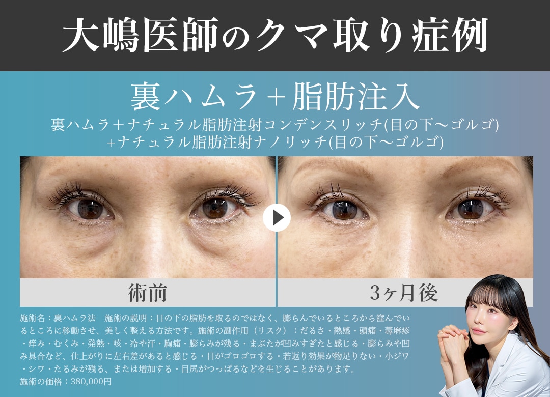 目の下の凹凸が強い方にオススメ