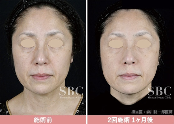 人にバレない、自然で上品な仕上がり