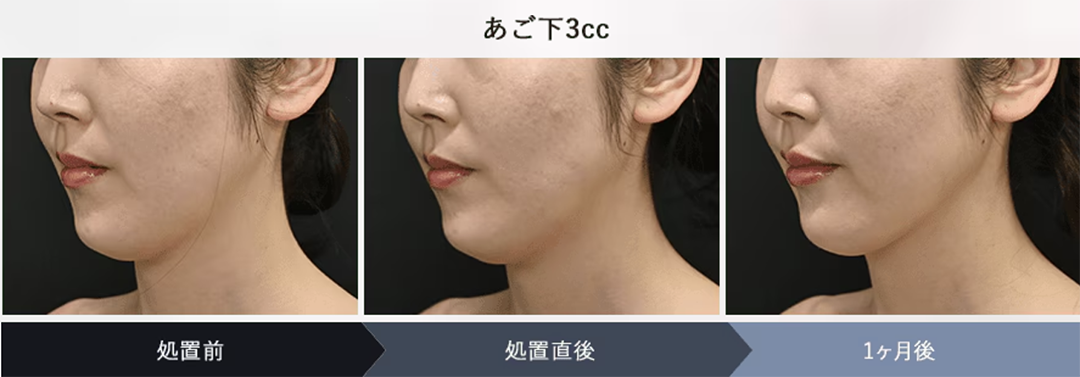 フェイスラインスッキリ