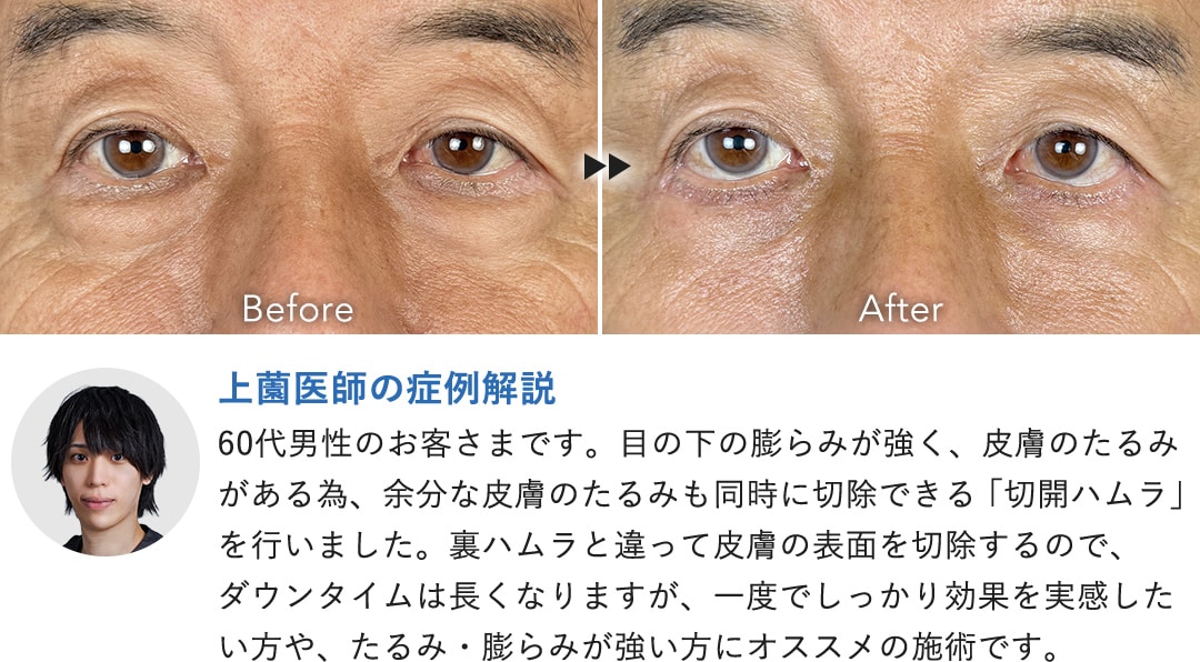 切開ハムラ