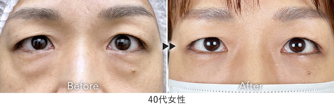 目の下の切らないクマ・たるみ取り(脱脂)＋脂肪注入