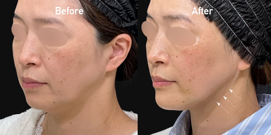 引き締まったハリのある小顔