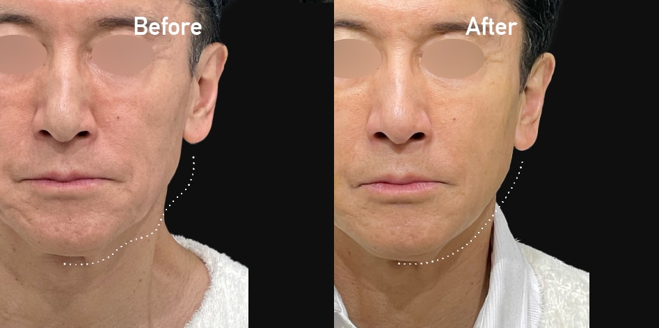 たるみ・もたつき改善