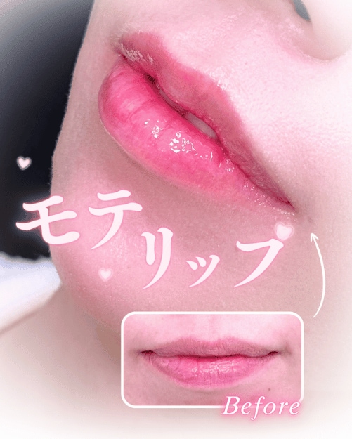 リップ症例写真