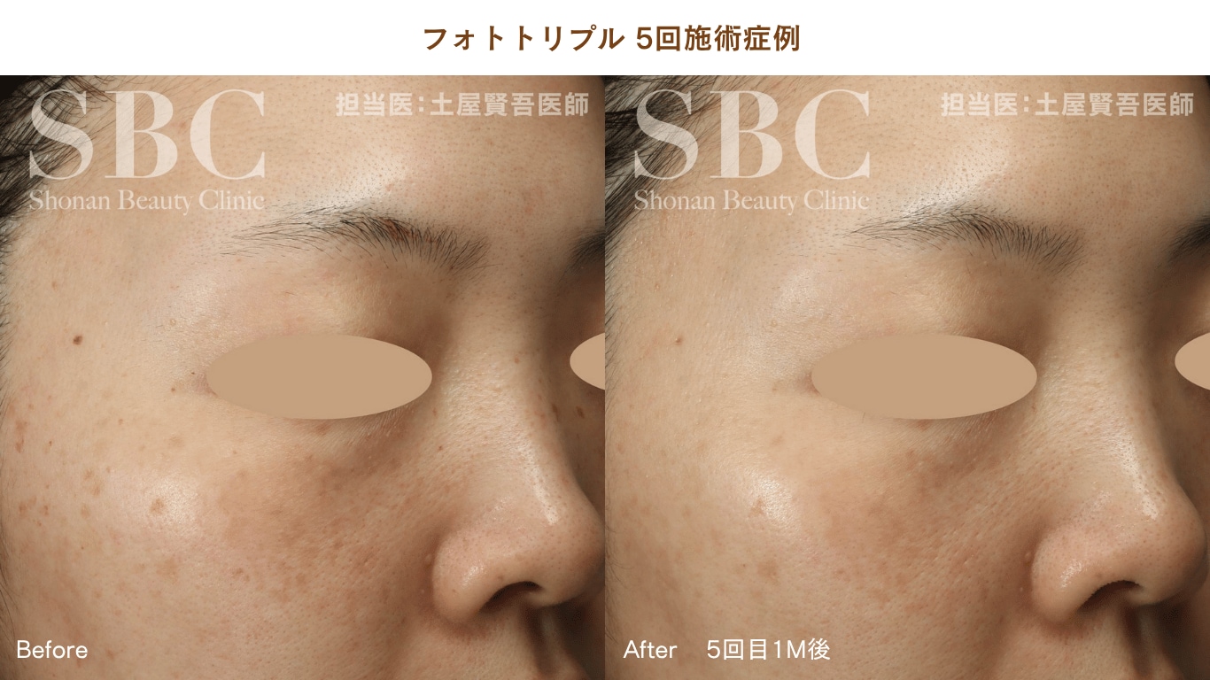 フォトトリ症例写真