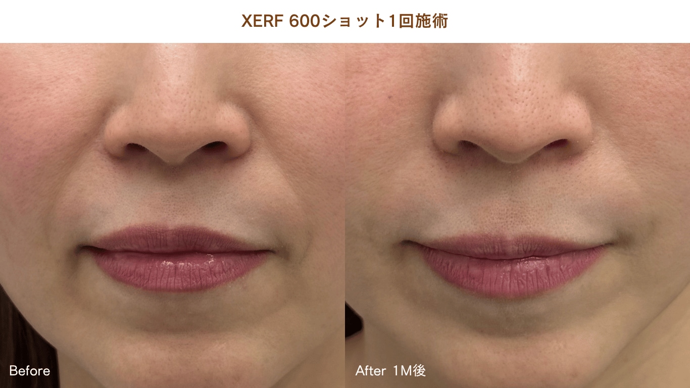 XERFが54,800円(税込)】天神西通り｜たるみ改善｜SBCスキンクリニック