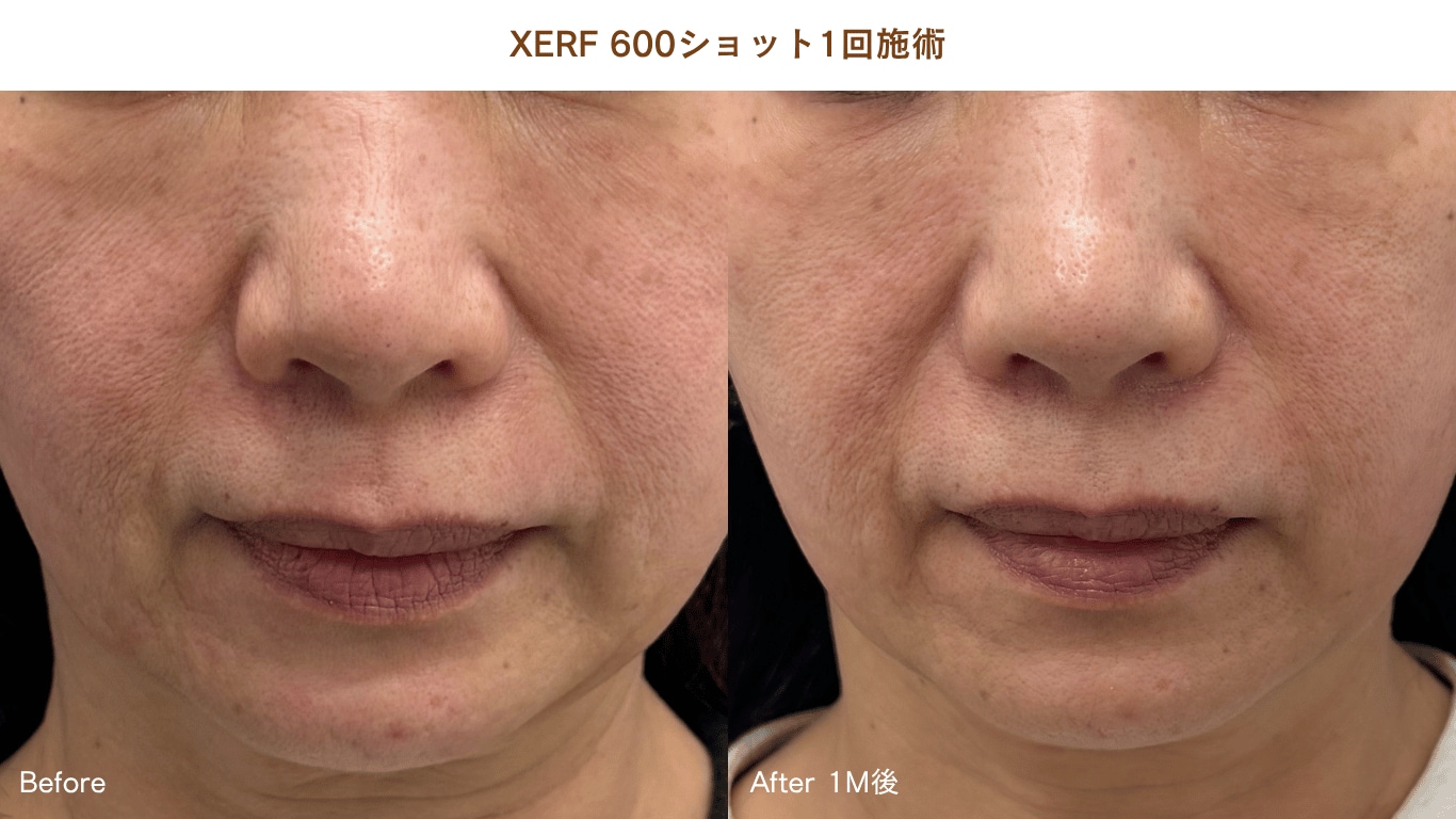XERF症例写真2