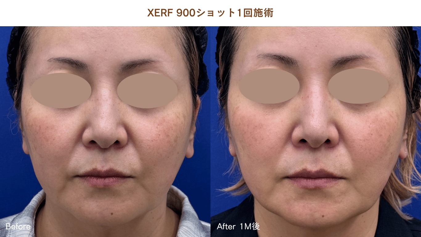 XERF症例写真3