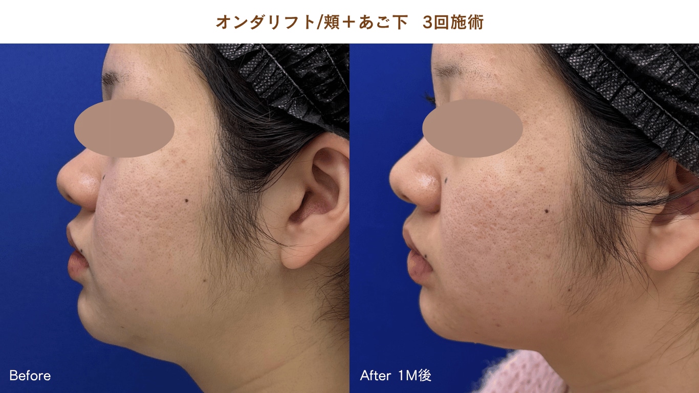 オンダリフト症例写真