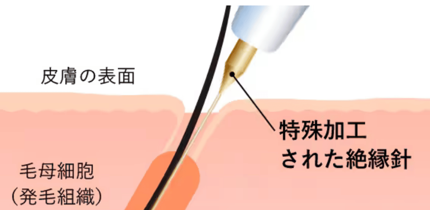 ニードル説明画像