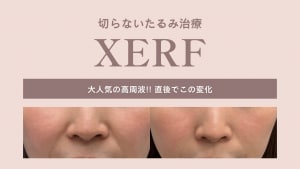 XERFのサムネ画像