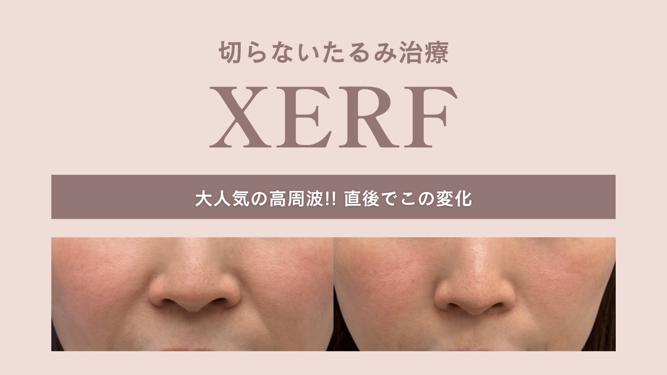 XERFのサムネ画像