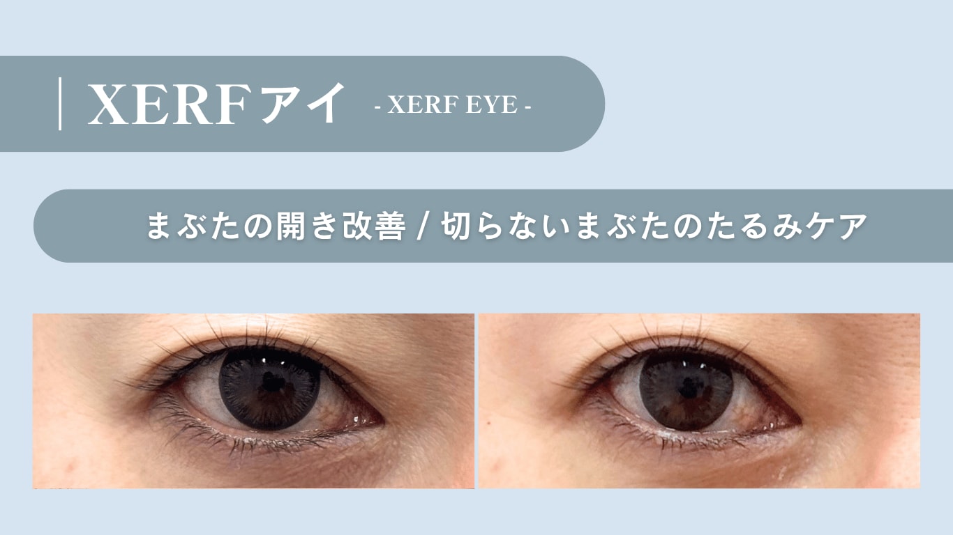 XERF アイサムネ画像
