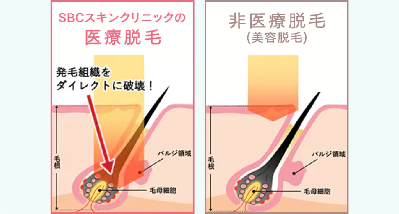 鹿児島 ヒゲ脱毛