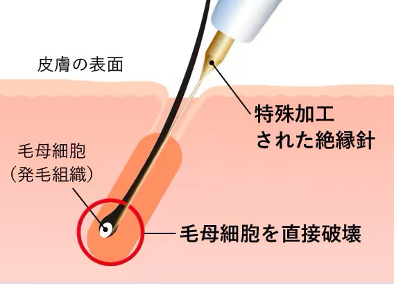 ニードル脱毛に仕組み