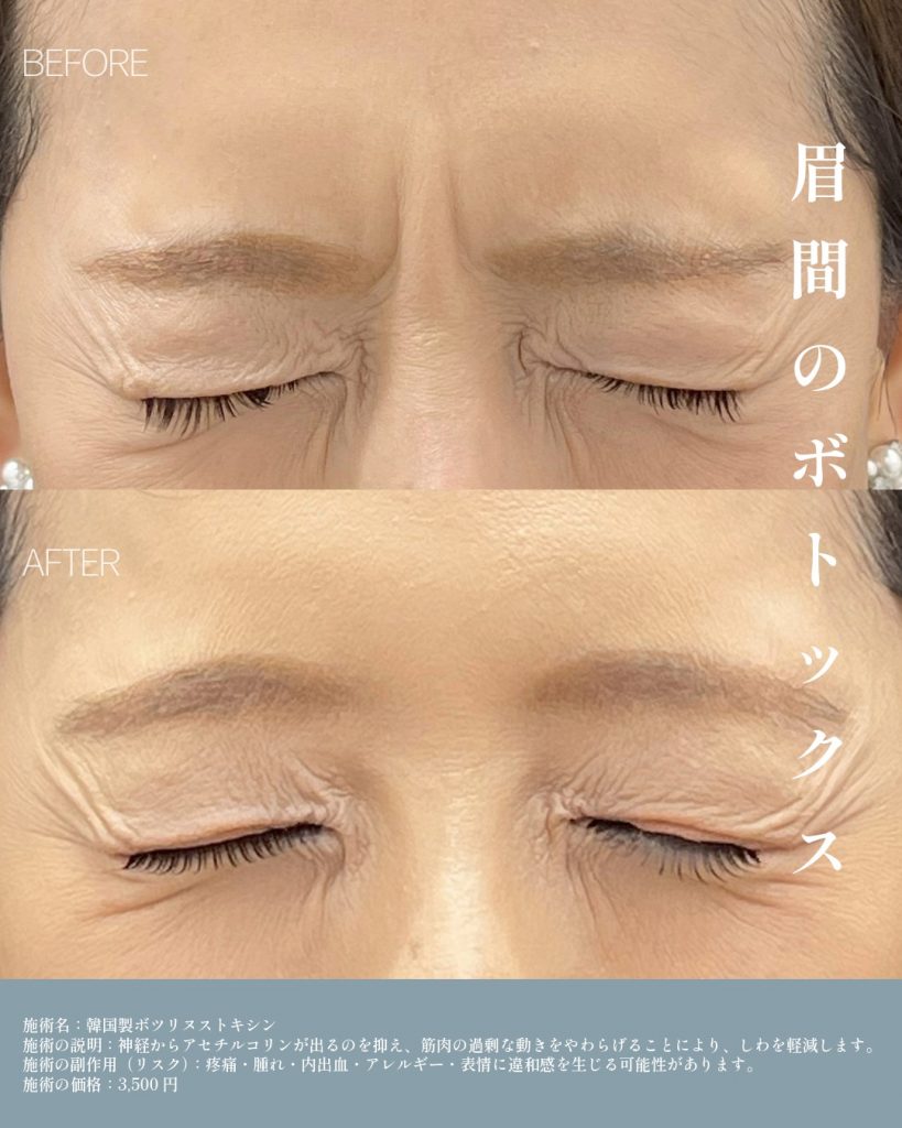 眉間ボトックス症例