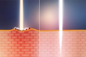 ピコウェイが他のピコレーザーより優れている点