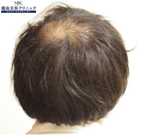 頭頂部の薄毛「つむじハゲ」の原因は男性型脱毛症（AGA ...