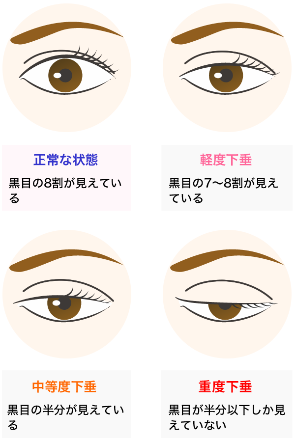 眼瞼下垂の重症度分類sp