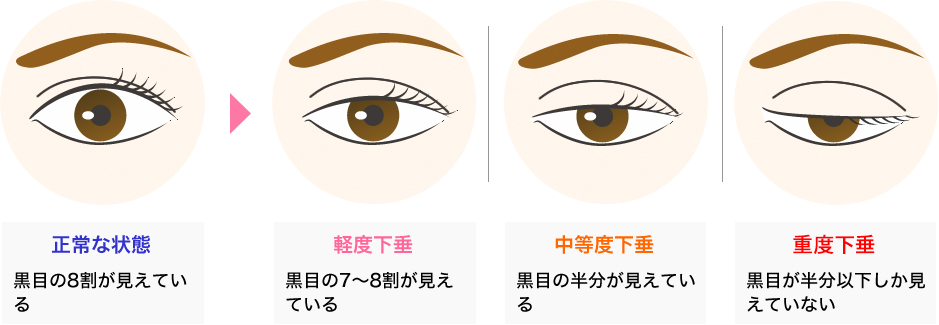 眼瞼下垂の重症度分類