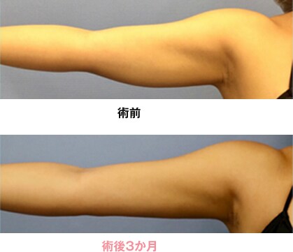 二の腕の症例写真03