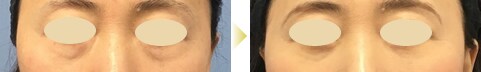 目の下の切らないたるみ取り症例写真03