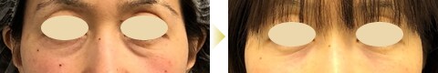 コンデンスリッチフェイス症例写真02