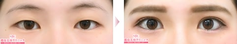 フォーエバー二重術症例写真01