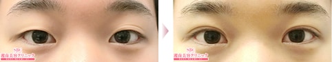 フォーエバー二重術症例写真03