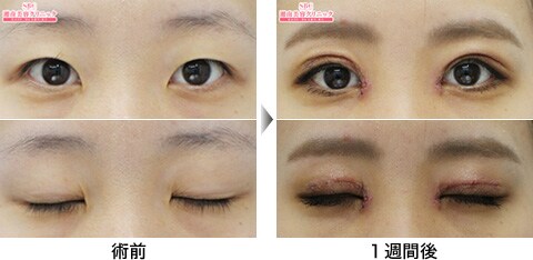 二重整形症例写真01