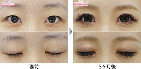 二重整形症例写真02
