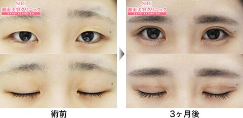 二重整形症例写真02