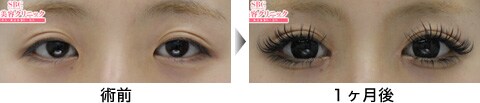 二重整形症例写真05