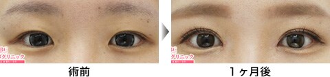 二重整形症例写真07