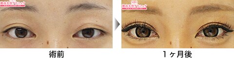 二重整形症例写真09