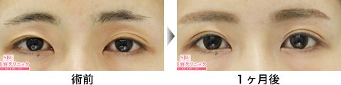 二重整形症例写真10
