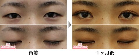 二重整形症例写真15