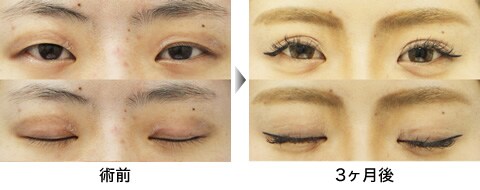 二重整形症例写真18