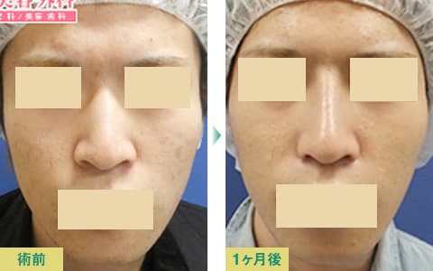 美鼻整形症例写真01